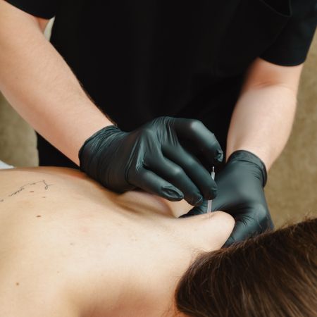 Terapia manualna z suchym igłowaniem
